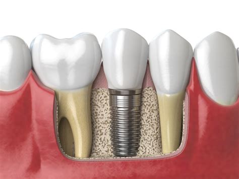 implant placement courses for general dentist.